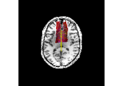 Linear fascicle evaluation (LiFE)