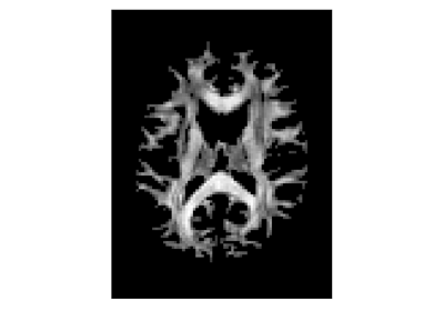 Using Various Stopping Criterion for Tractography